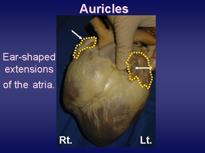 Auricles Ear-shaped extensions of the atria. Rt. Lt. 