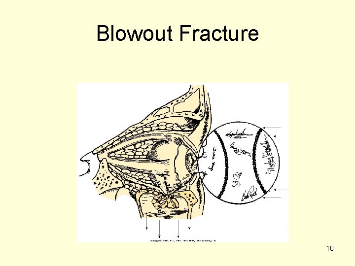 Blowout Fracture 10 