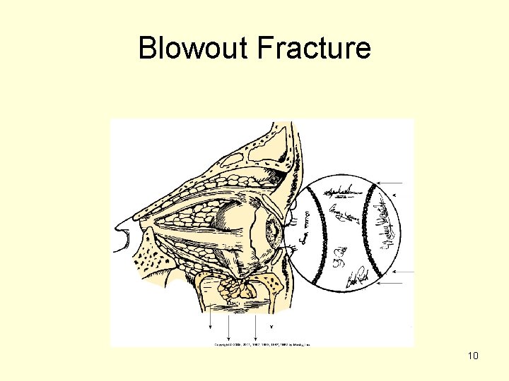 Blowout Fracture 10 Blowout Fracture 10
