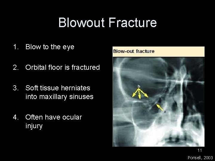 Blowout Fracture 1. Blow to the eye 2. Orbital floor is fractured 3. Soft