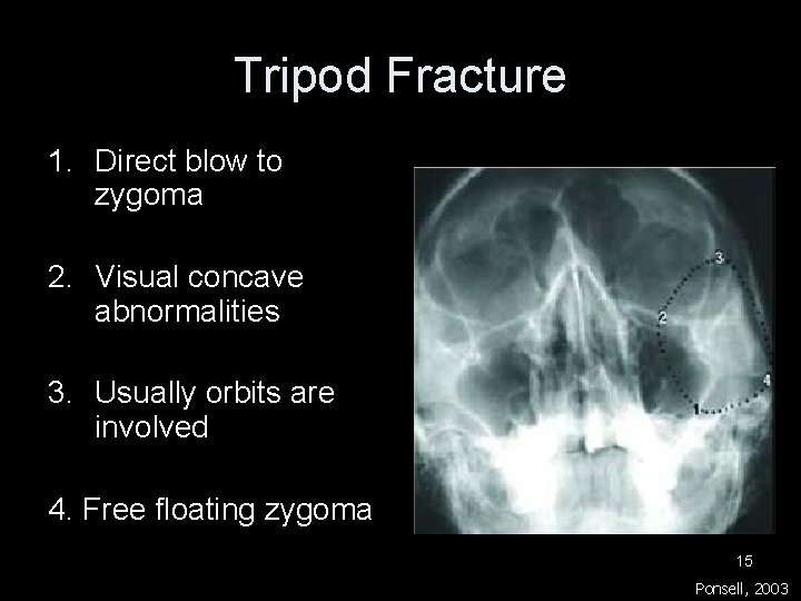 Tripod Fracture 1. Direct blow to zygoma 2. Visual concave abnormalities 3. Usually orbits Tripod Fracture 1. Direct blow to zygoma 2. Visual concave abnormalities 3. Usually orbits