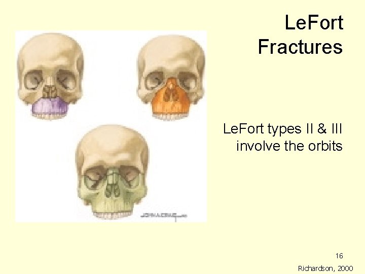 Le. Fort Fractures Le. Fort types II & III involve the orbits 16 Richardson, Le. Fort Fractures Le. Fort types II & III involve the orbits 16 Richardson,