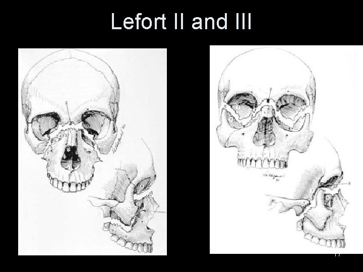 Lefort II and III 17 