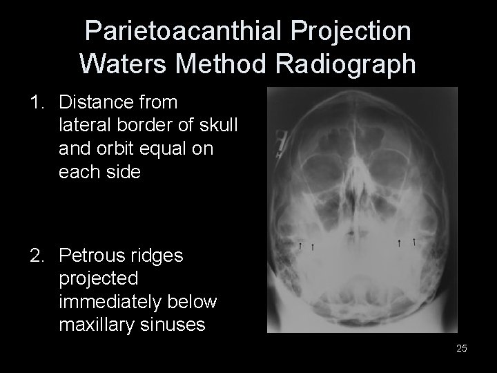 Parietoacanthial Projection Waters Method Radiograph 1. Distance from lateral border of skull and orbit