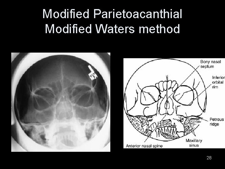 Modified Parietoacanthial Modified Waters method 28 