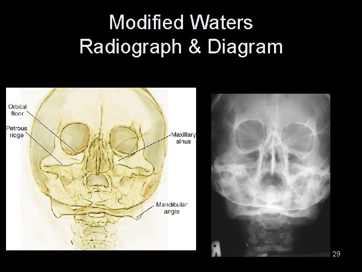 Modified Waters Radiograph & Diagram 29 Modified Waters Radiograph & Diagram 29