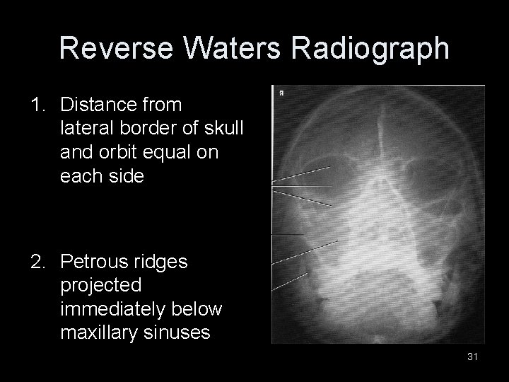 Reverse Waters Radiograph 1. Distance from lateral border of skull and orbit equal on Reverse Waters Radiograph 1. Distance from lateral border of skull and orbit equal on