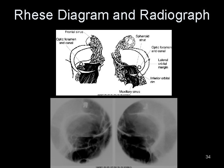 Rhese Diagram and Radiograph 34 