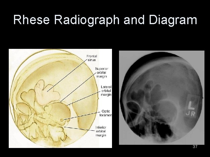 Rhese Radiograph and Diagram 37 Rhese Radiograph and Diagram 37