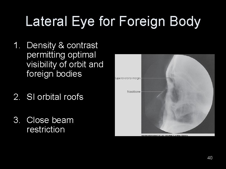 Lateral Eye for Foreign Body 1. Density & contrast permitting optimal visibility of orbit
