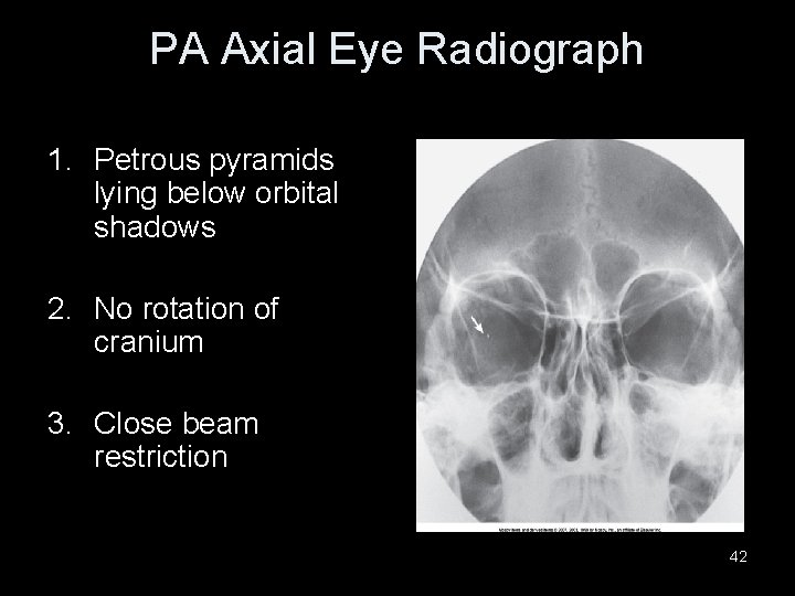 PA Axial Eye Radiograph 1. Petrous pyramids lying below orbital shadows 2. No rotation