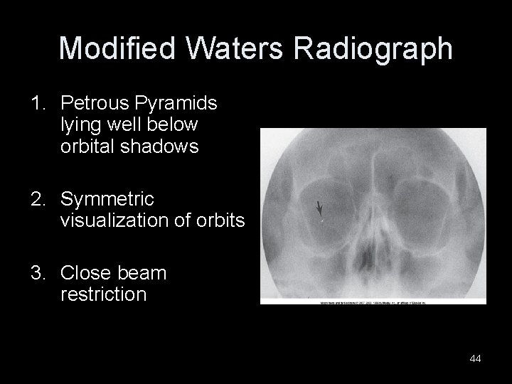 Modified Waters Radiograph 1. Petrous Pyramids lying well below orbital shadows 2. Symmetric visualization