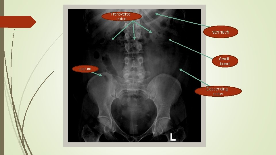 Transverse colon stomach Small bowel cecum Descending colon 