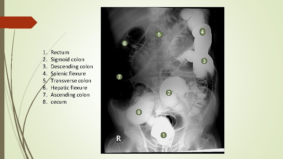 4 5 6 1. 2. 3. 4. 5. 6. 7. 8. Rectum Sigmoid colon