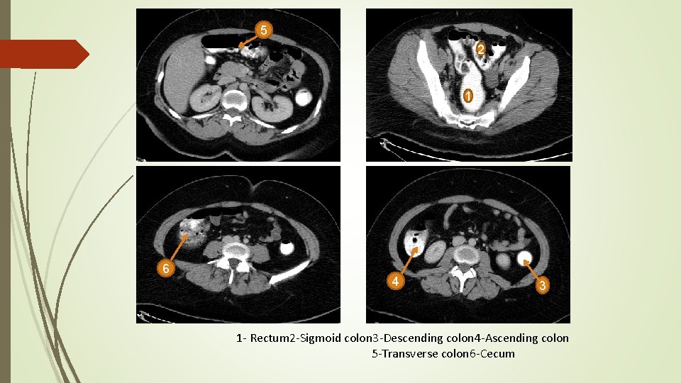 5 2 1 6 4 3 1 - Rectum 2 -Sigmoid colon 3 -Descending