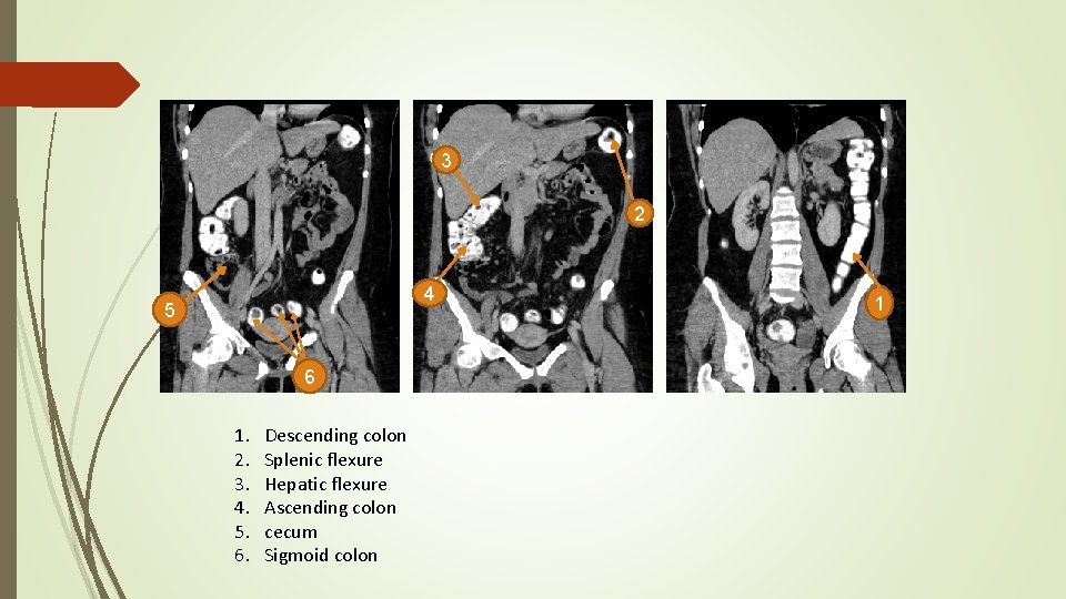 3 2 4 5 6 1. 2. 3. 4. 5. 6. Descending colon Splenic
