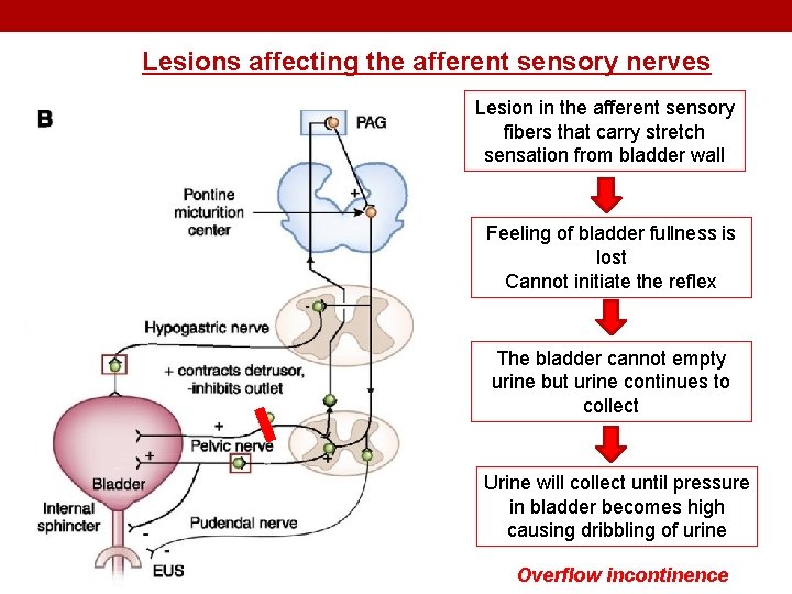 Lesions affecting the afferent sensory nerves Lesion in the afferent sensory fibers that carry