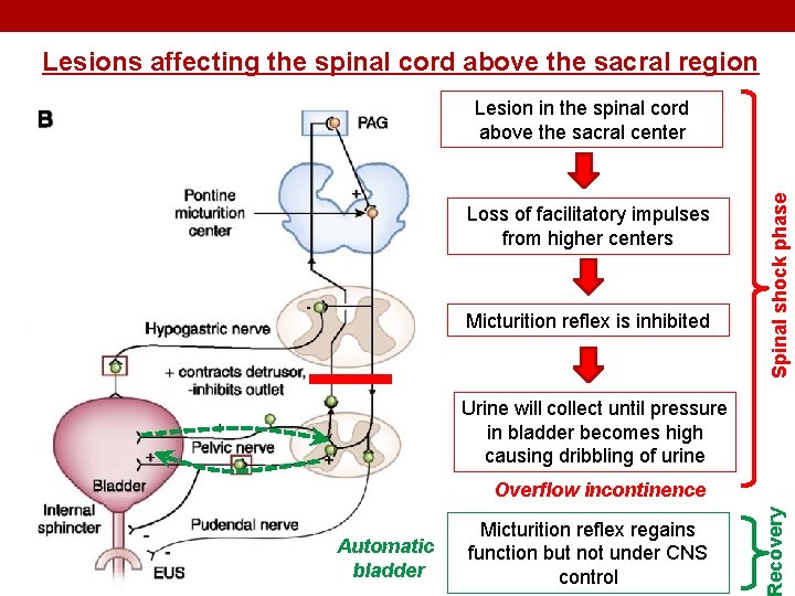 Lesions affecting the spinal cord above the sacral region Loss of facilitatory impulses from