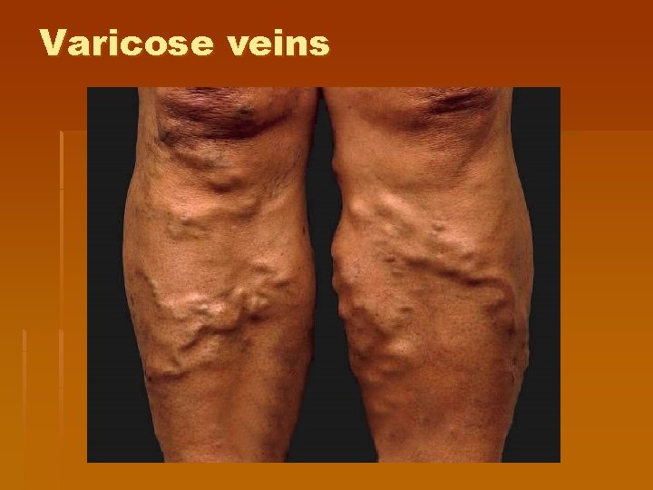 Varicose veins 