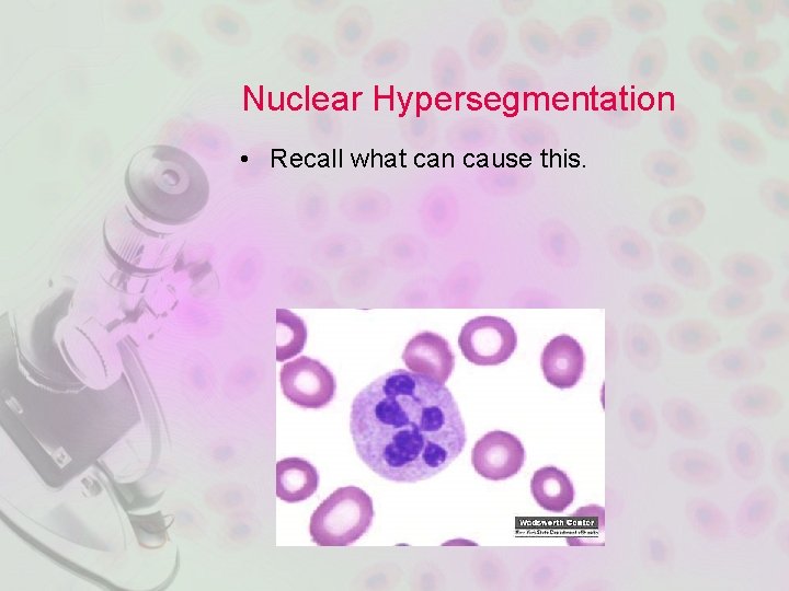 Nuclear Hypersegmentation • Recall what can cause this. 