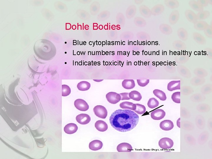 Dohle Bodies • Blue cytoplasmic inclusions. • Low numbers may be found in healthy