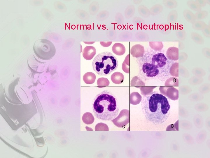 Normal vs. Toxic Neutrophils 