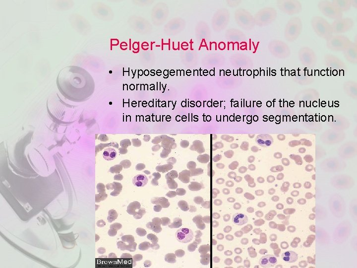 Pelger-Huet Anomaly • Hyposegemented neutrophils that function normally. • Hereditary disorder; failure of the