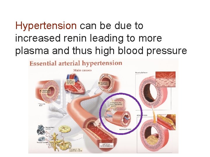 Hypertension can be due to increased renin leading to more plasma and thus high