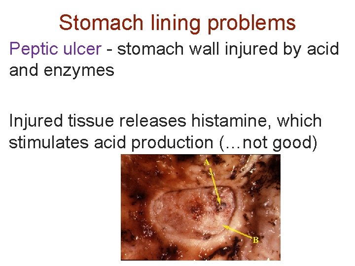 Stomach lining problems Peptic ulcer - stomach wall injured by acid and enzymes Injured