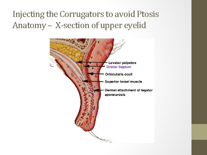 Injecting the Corrugators to avoid Ptosis Anatomy – X-section of upper eyelid 