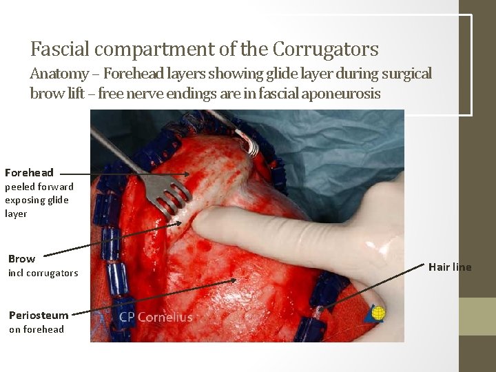 Fascial compartment of the Corrugators Anatomy – Forehead layers showing glide layer during surgical