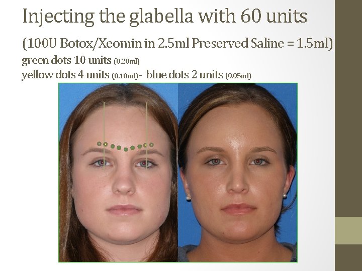 Injecting the glabella with 60 units (100 U Botox/Xeomin in 2. 5 ml Preserved