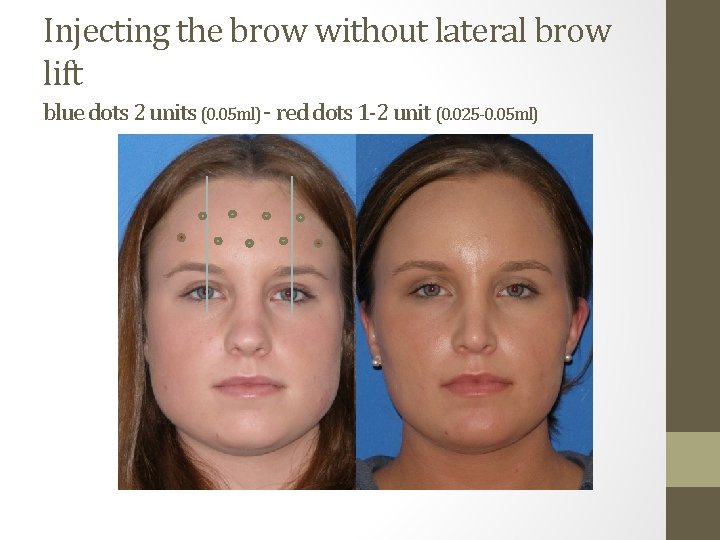 Injecting the brow without lateral brow lift blue dots 2 units (0. 05 ml)