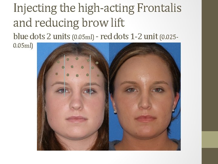 Injecting the high-acting Frontalis and reducing brow lift blue dots 2 units (0. 05