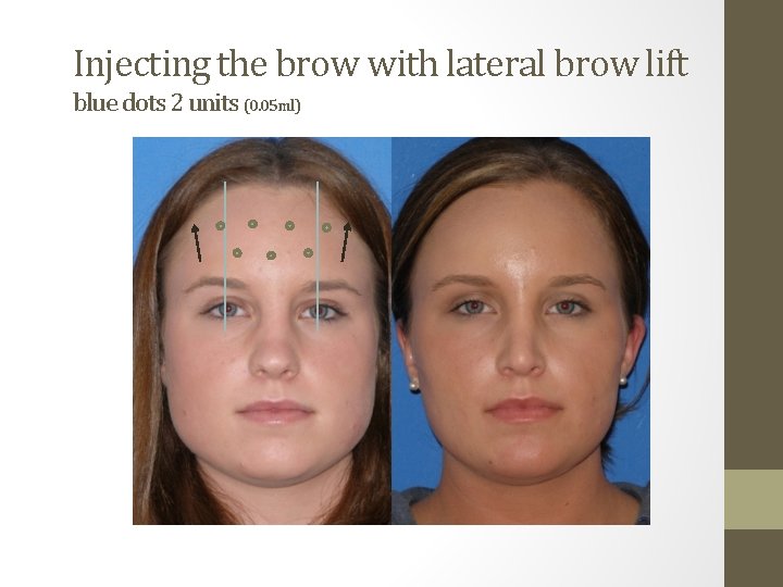 Injecting the brow with lateral brow lift blue dots 2 units (0. 05 ml)