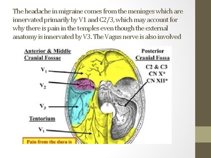 The headache in migraine comes from the meninges which are innervated primarily by V