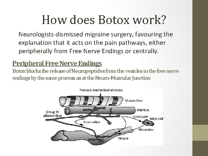 How does Botox work? Neurologists dismissed migraine surgery, favouring the explanation that it acts