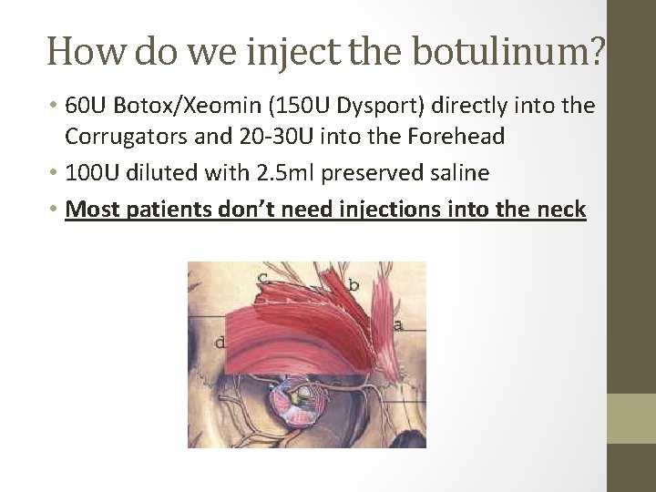 How do we inject the botulinum? • 60 U Botox/Xeomin (150 U Dysport) directly
