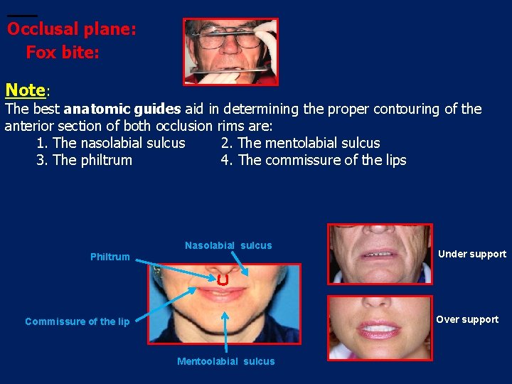Occlusal plane: Fox bite: Note: The best anatomic guides aid in determining the proper