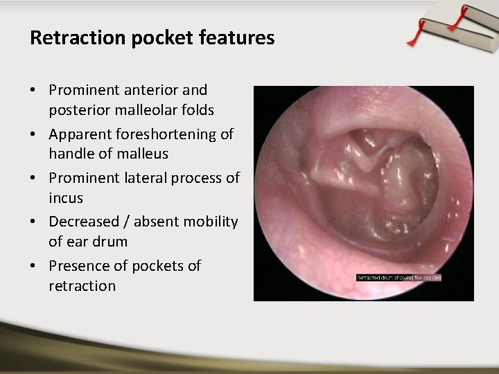 Retraction pocket features • Prominent anterior and posterior malleolar folds • Apparent foreshortening of