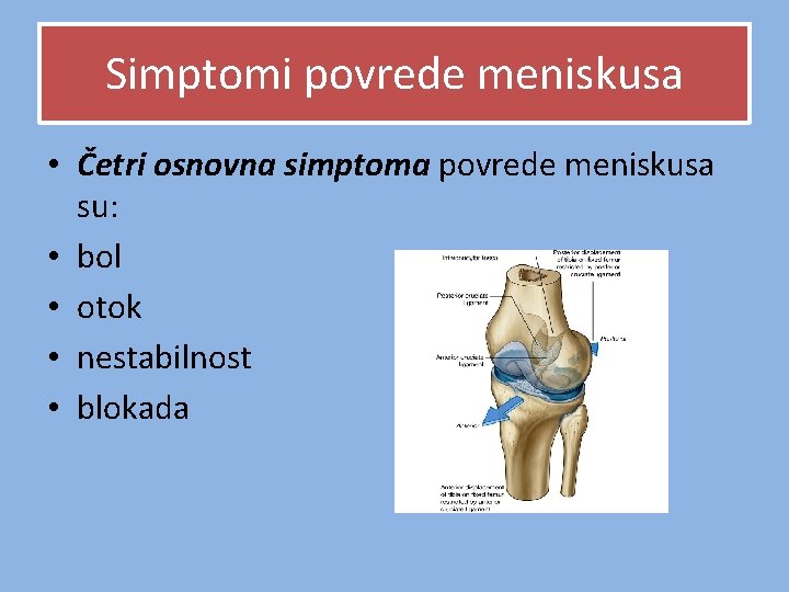 Simptomi povrede meniskusa • Četri osnovna simptoma povrede meniskusa su: • bol • otok Simptomi povrede meniskusa • Četri osnovna simptoma povrede meniskusa su: • bol • otok
