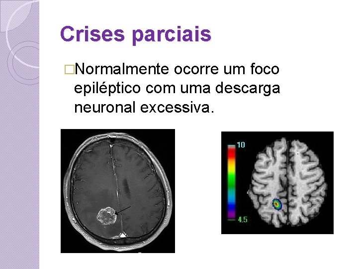 Crises parciais �Normalmente ocorre um foco epiléptico com uma descarga neuronal excessiva. 