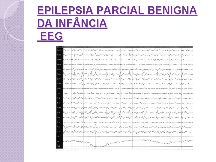 EPILEPSIA PARCIAL BENIGNA DA INF NCIA EEG 