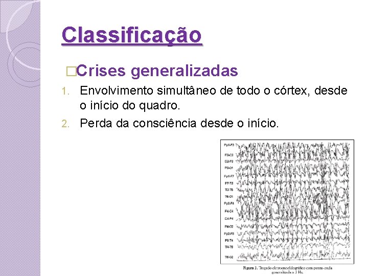 Classificação �Crises generalizadas Envolvimento simultâneo de todo o córtex, desde o início do quadro.