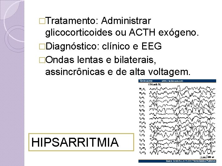 �Tratamento: Administrar glicocorticoides ou ACTH exógeno. �Diagnóstico: clínico e EEG �Ondas lentas e bilaterais,