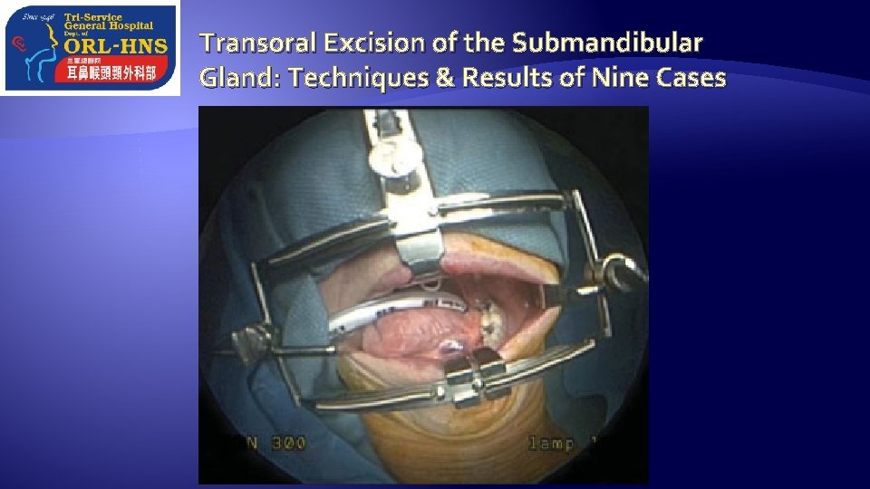 Transoral Excision of the Submandibular Gland: Techniques & Results of Nine Cases 