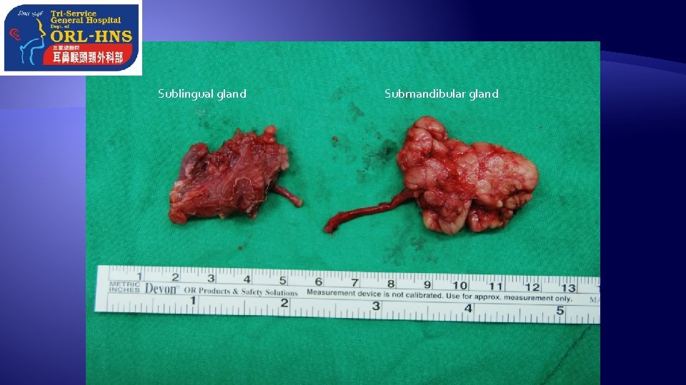 Sublingual gland Submandibular gland 