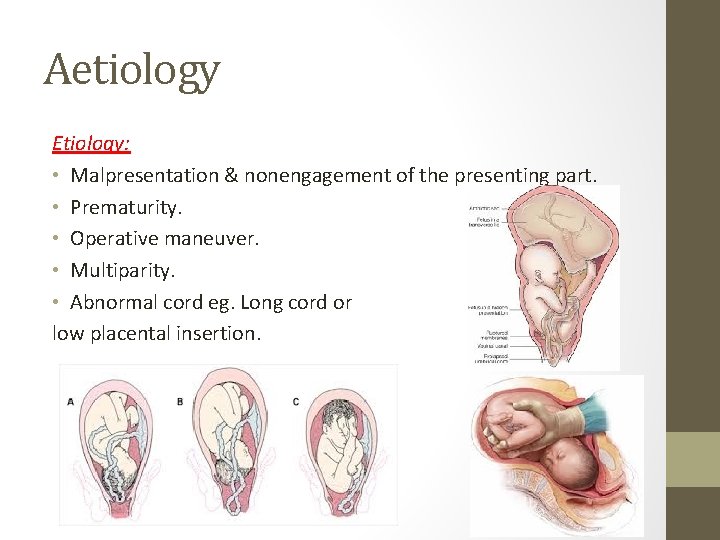 Aetiology Etiology: • Malpresentation & nonengagement of the presenting part. • Prematurity. • Operative