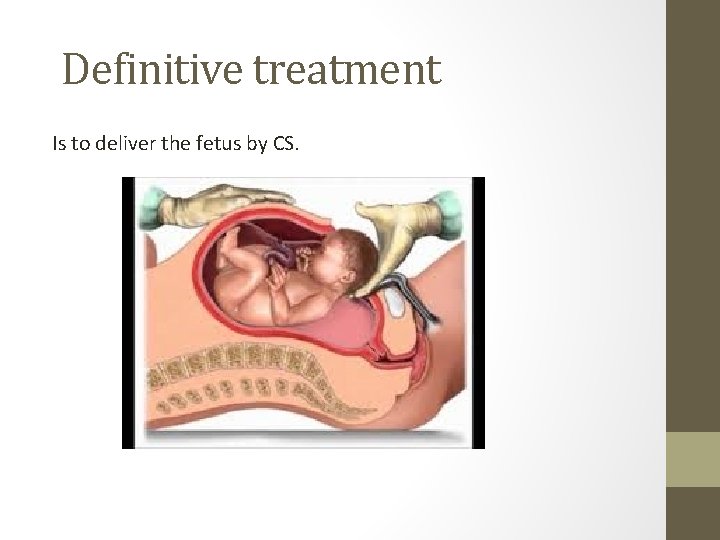 Definitive treatment Is to deliver the fetus by CS. 