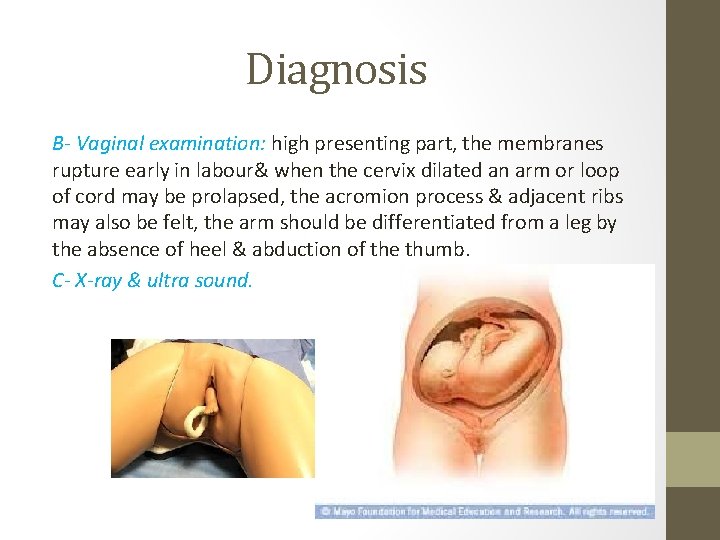 Diagnosis B- Vaginal examination: high presenting part, the membranes rupture early in labour& when